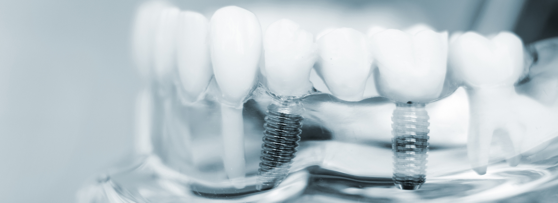 Remmers Dental | Emergency Treatment, Sports Mouthguards and Ceramic Crowns