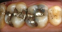 Dental Implants Dentist in Louisville