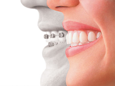 Remmers Dental | Root Canals, Teeth Whitening and Snoring Appliances