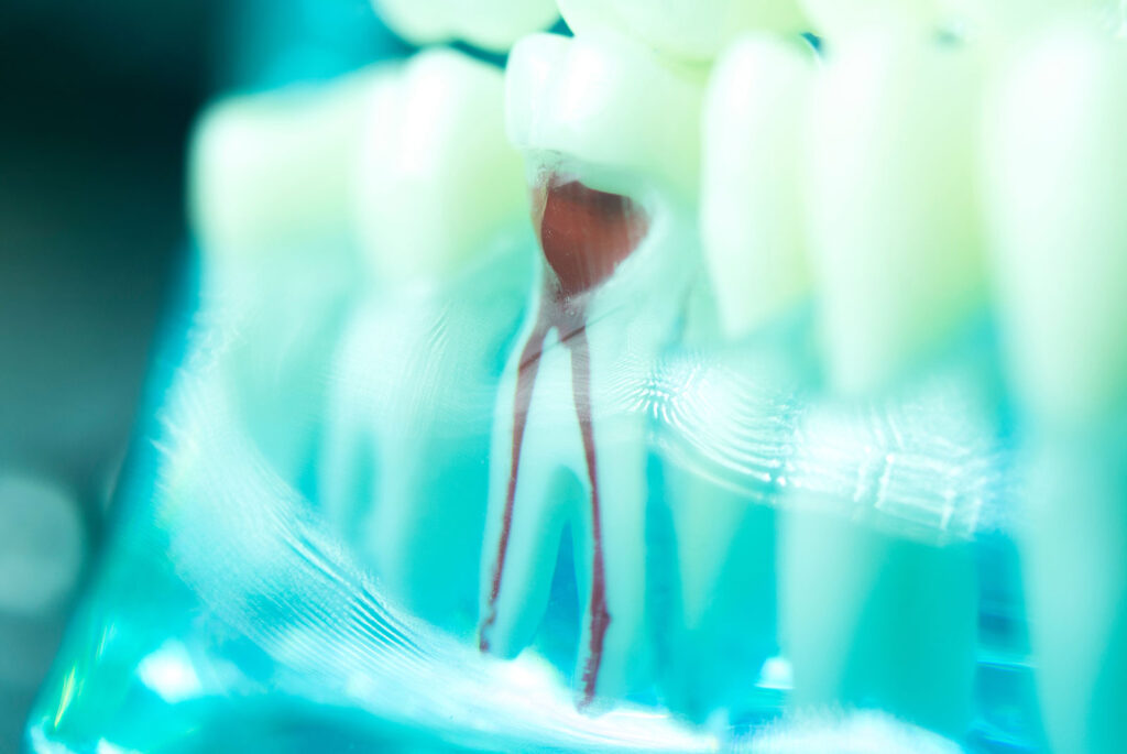 Dental tooth root canal