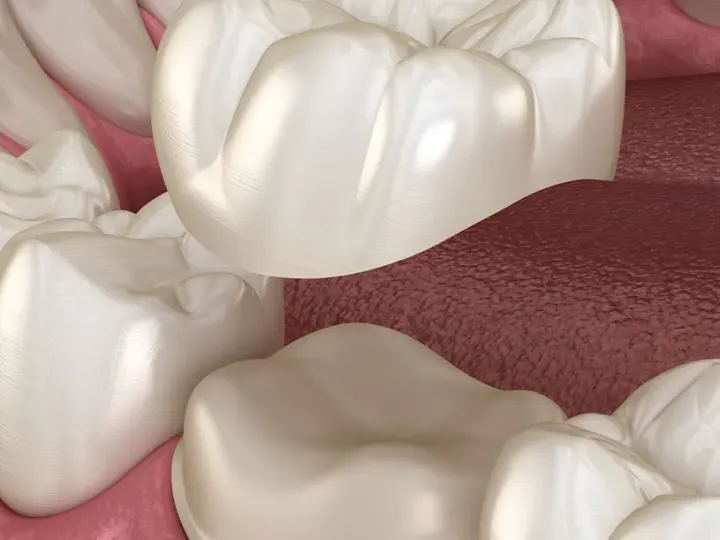 close up illustration of dental crown