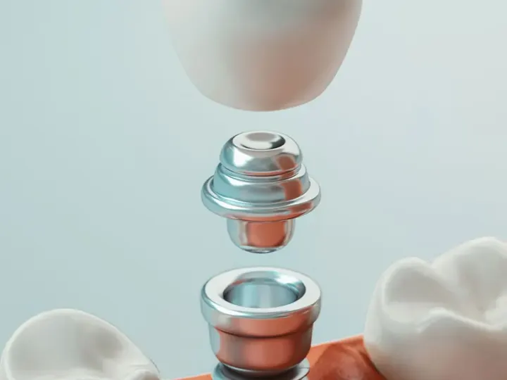illustration of single dental implant