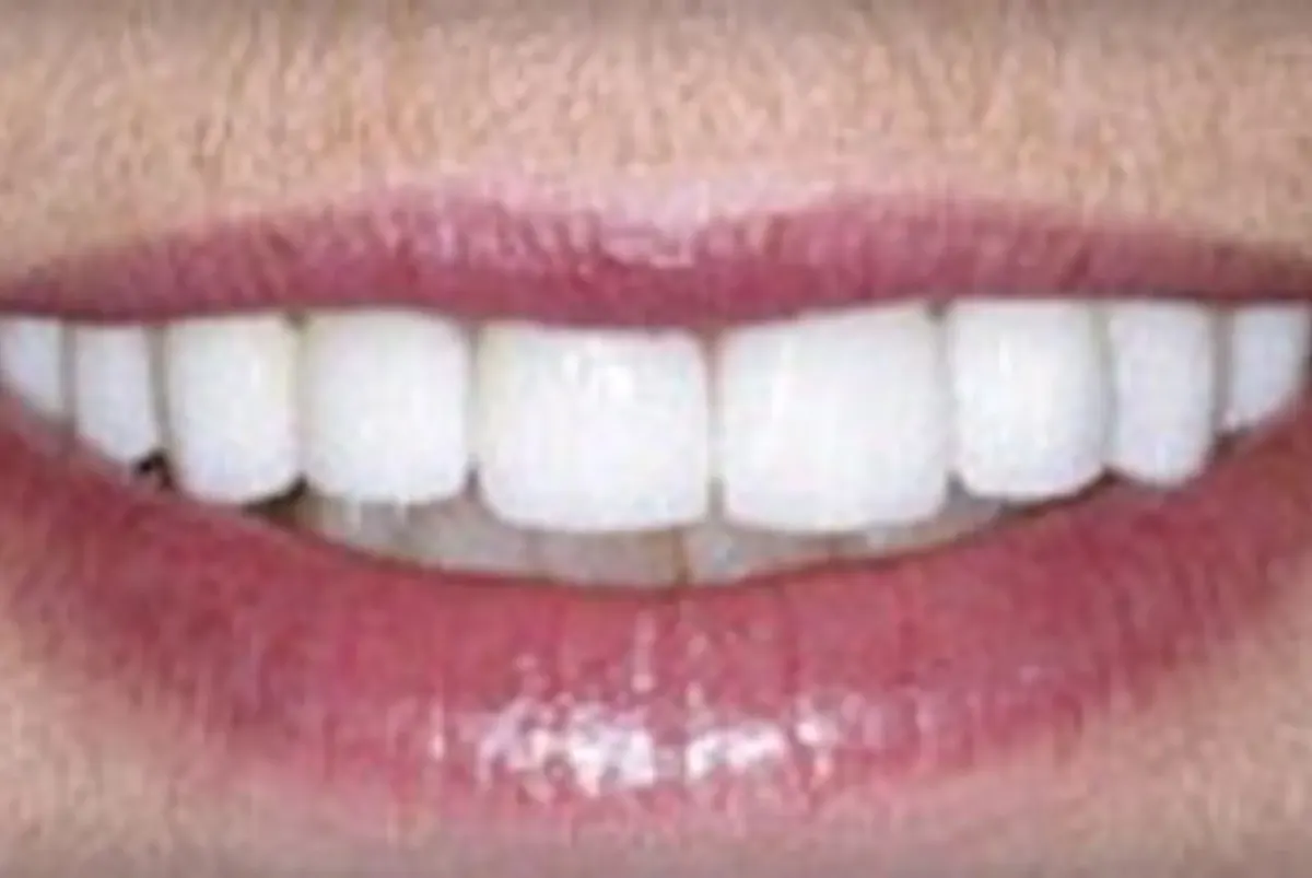 After: Dental Implants