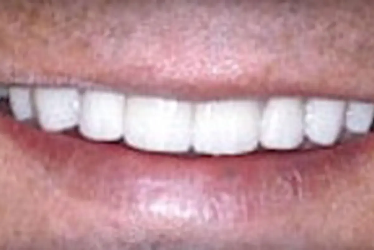 After: Dental Implants