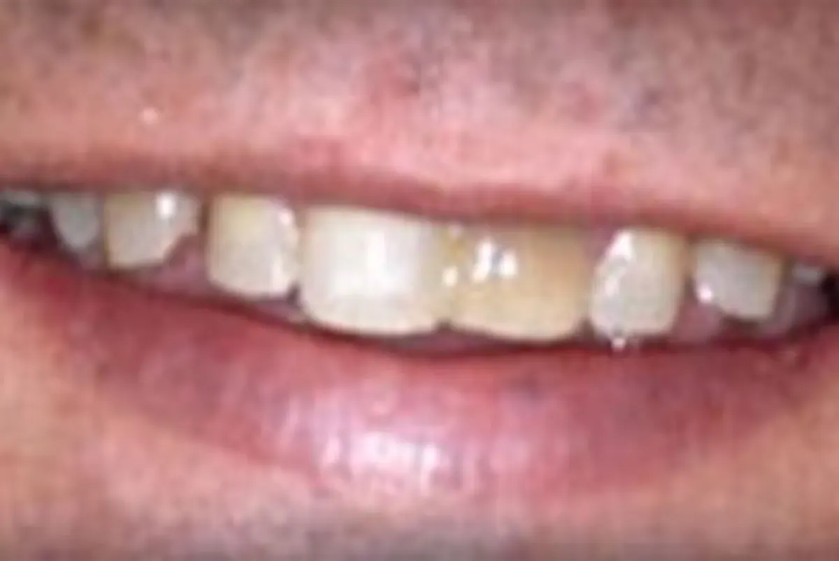 Before: Dental Implants