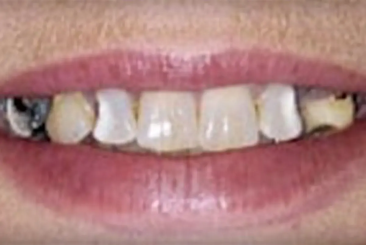 Before: Dental Implants